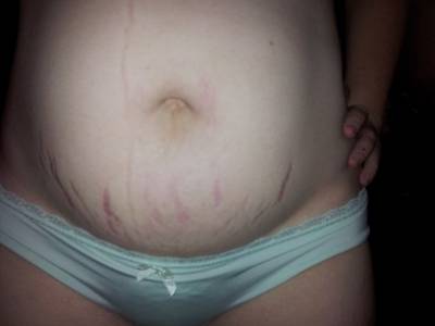 model Pure Warrior Maiden body modelling photo taken by @Stephanos_Baecere . this is an image of my belly after having my first child back in january 2014  i had the image taken about a month after his birth  i have not taken any since.